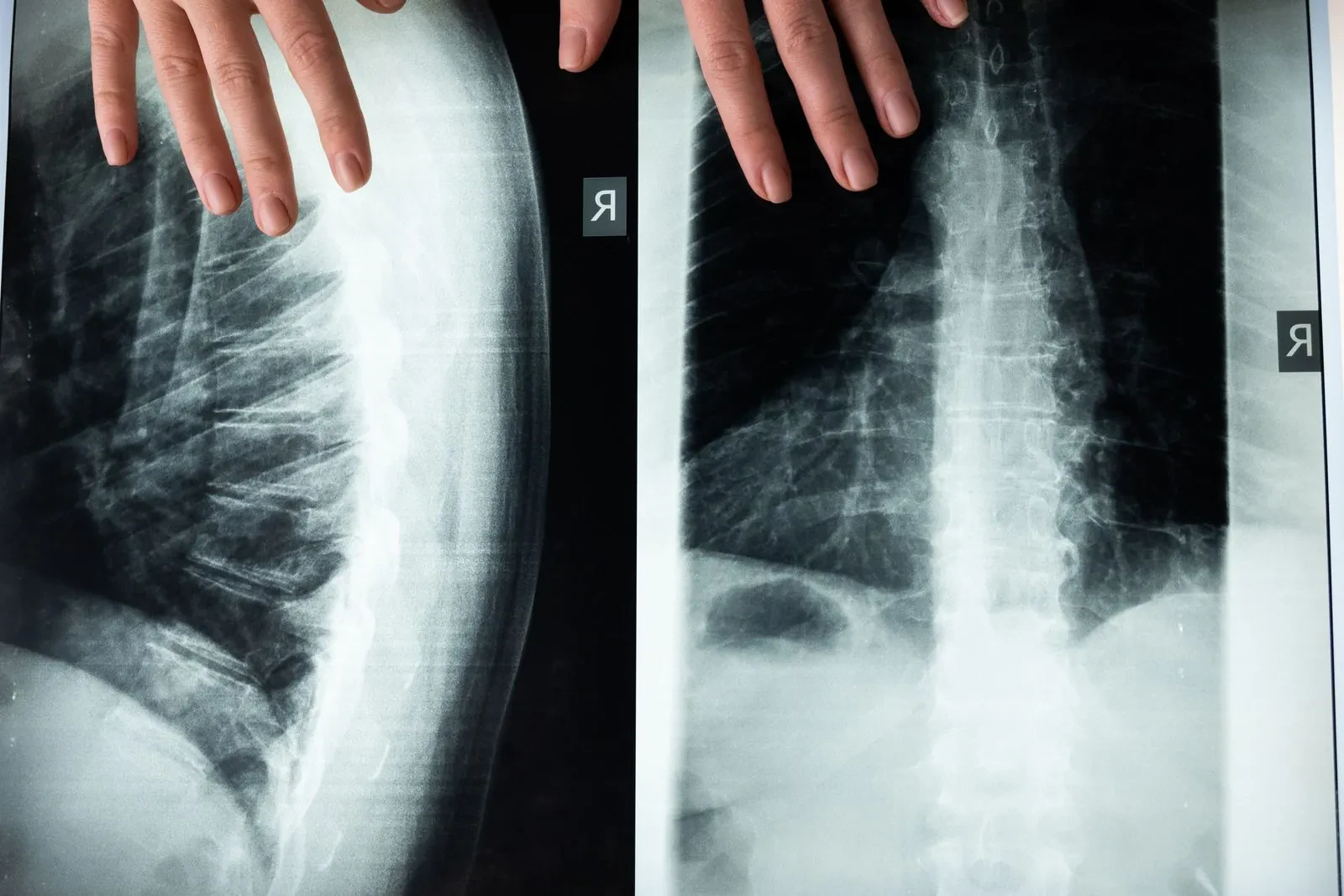 Reviewing a spinal X-ray